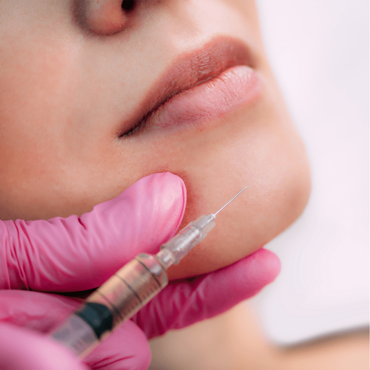 Silkpeel Dermal Infusion